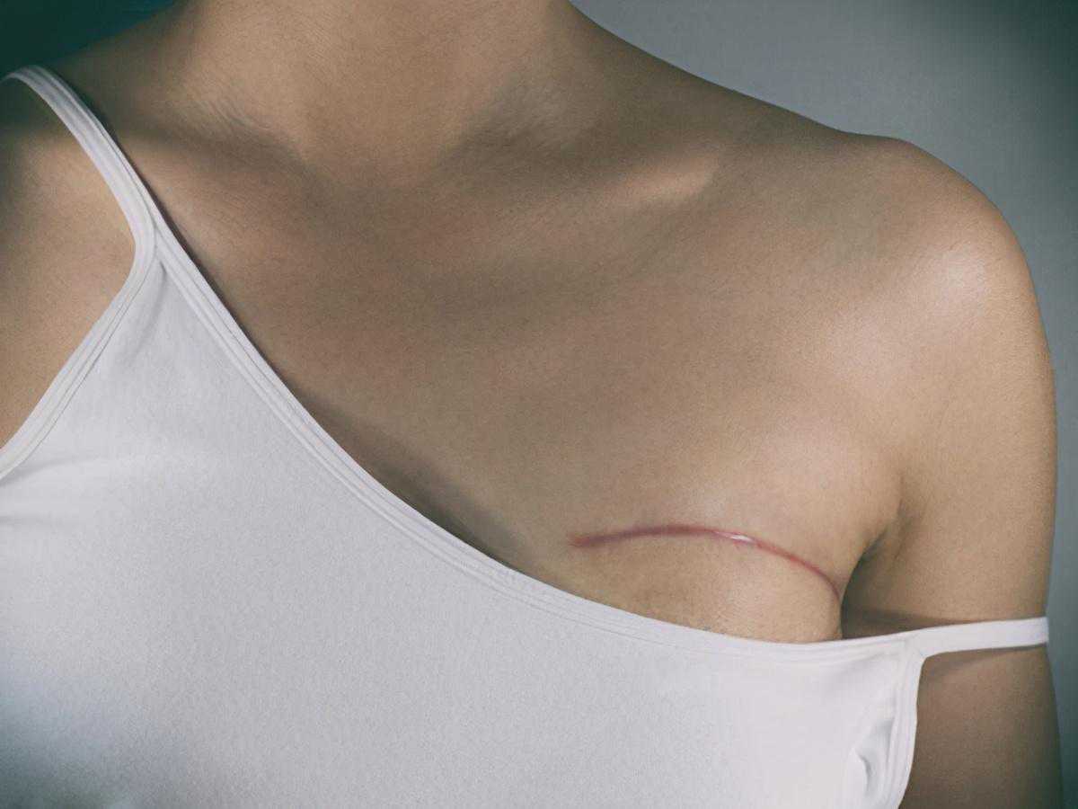 乳腺癌术后的胸壁结节都是恶性的吗？
